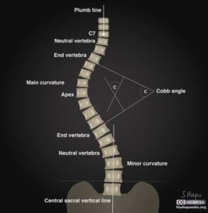 Scoliosis relief. Spotsylvania chiropractor. Fredericksburg chiropractor. Chiropractic orthopedist. Chiropractor near me. Back pain. Cobb angle.