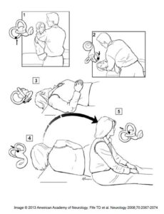 The use of the Epley's maneuver. Fredericksburg and Spotsylvania.