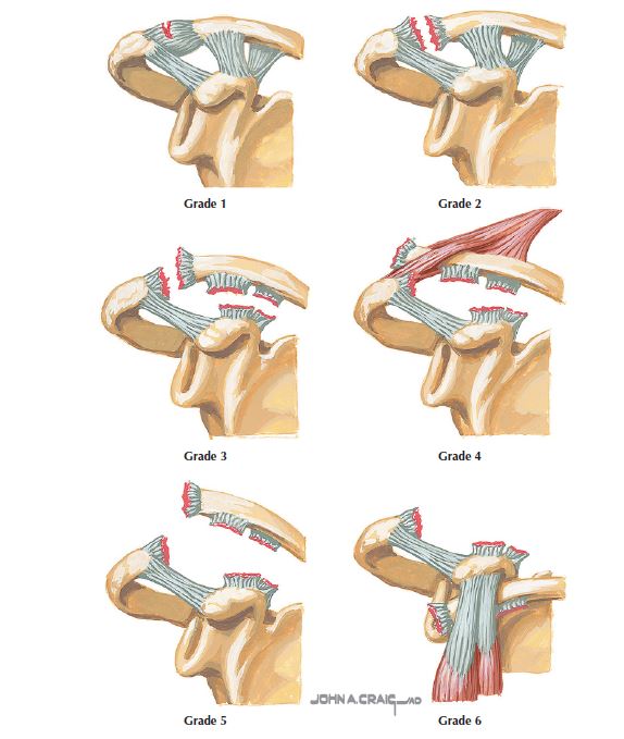 AC joint injury, AC joint separation, acromioclavicular joint injury, chiropractic orthopedics, Fredericksburg chiropractor.