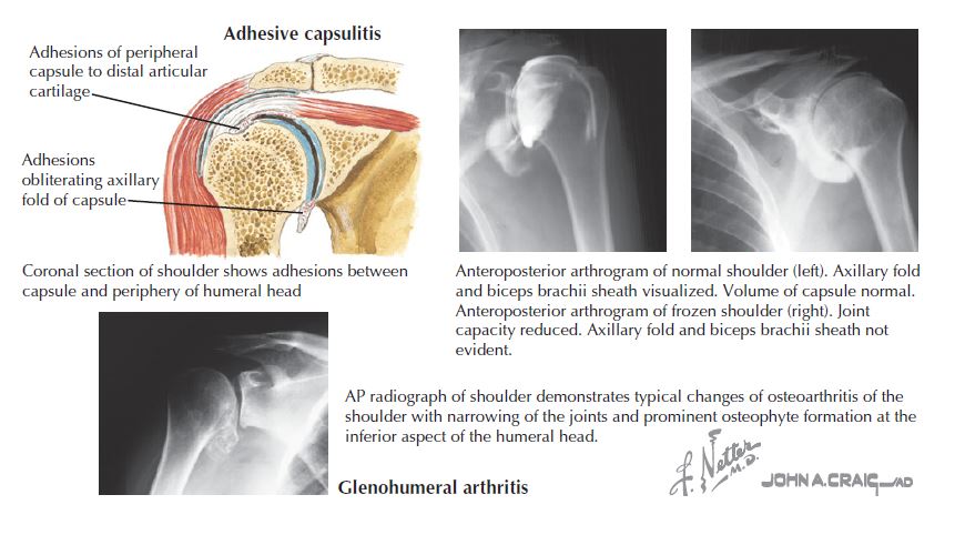 adhesive capsulitis, frozen shoulder, Fredericksburg chiropractor, chiropractic orhtopedist