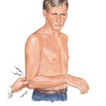 Tennis elbow, lateral epicondylitis, Fredericksburg chiropractor, elbow pain