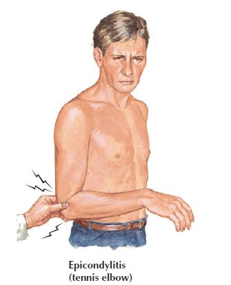 Tennis elbow, lateral epicondylitis, Fredericksburg chiropractor, elbow pain