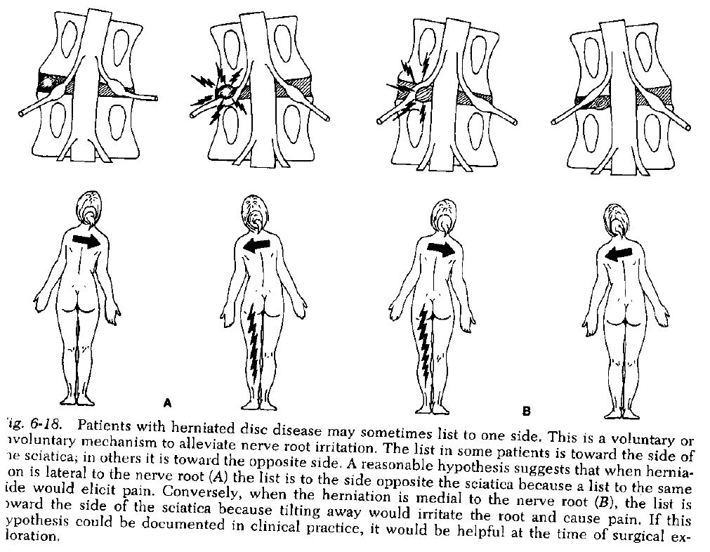 Bulging disc, Protruding disc, Fredericksburg Chiropractor, chiropractic orthopedist, antalgia, sciatica, crooked when walking.