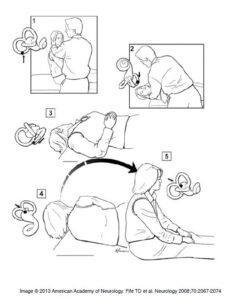 The use of the Epley's maneuver. Used commonly in posterior canal BPPV. One of the causes of dizziness or vertigo.