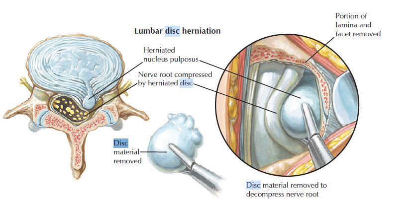 Lumbar disc herniation as illustrated by Dr. Netter. In this case the nucleus has gone through all the layers of the annulus and can be termed more correctly as extrusion as used in our writing.